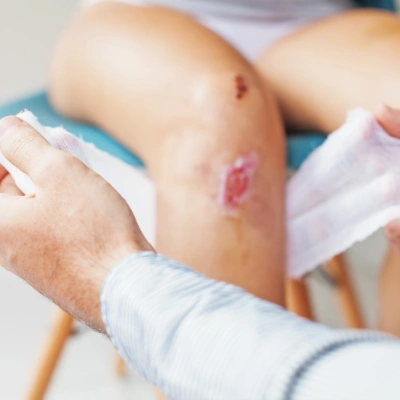 close up of wound west coast wound care