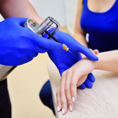 woman getting cryotherapy wound treatment west coast wound care
