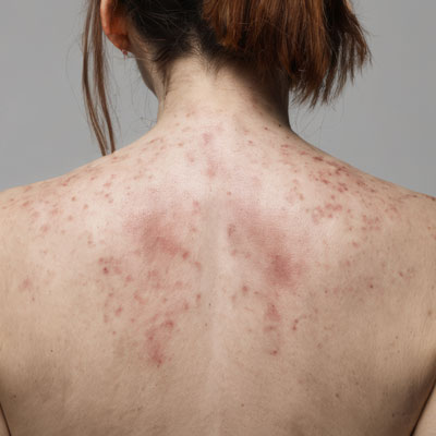 Dermatological conditions