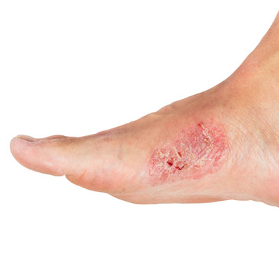 Diabetic ulcer