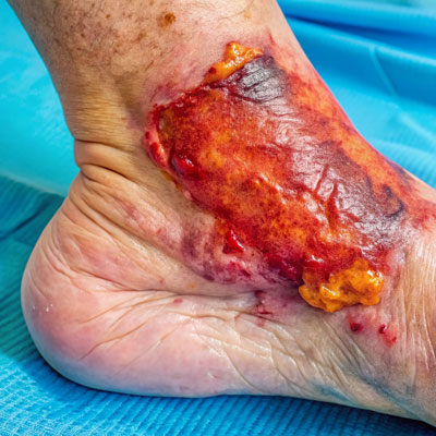 chronic non healing wounds
