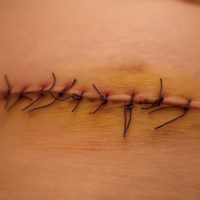 post surgical wounds