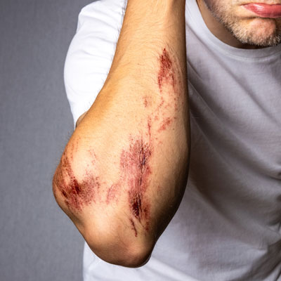 trauma wound