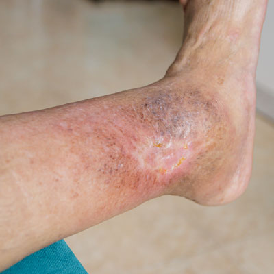 vascular ulcer