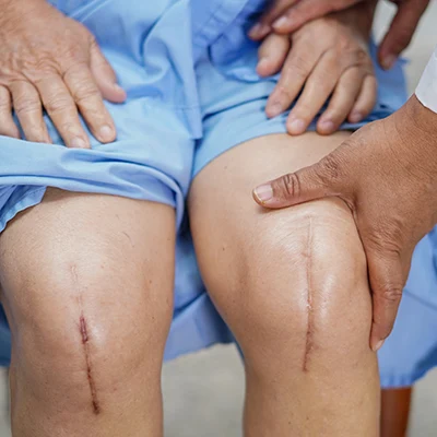 Close-up of patient's knees with prominent surgical scars after knee replacement.